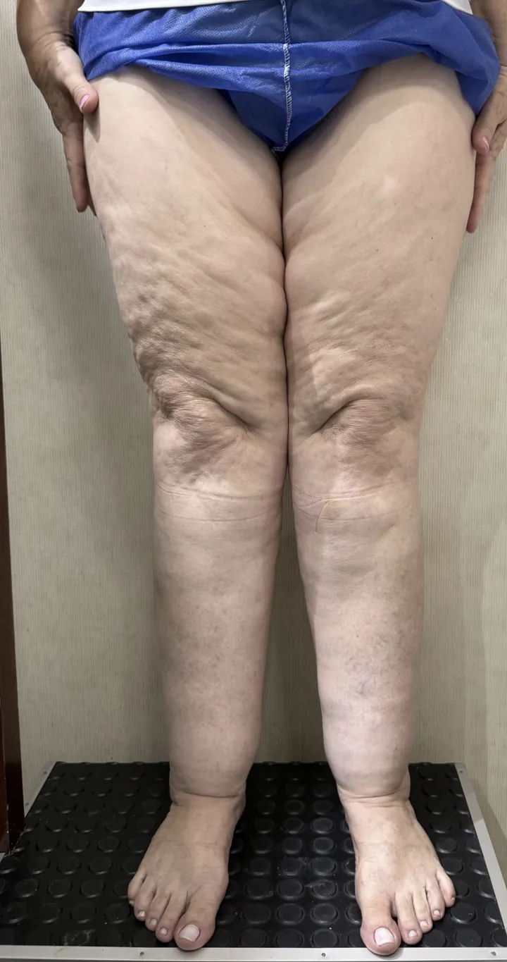 Foto demonstrativa: pernas com lipedema, com acúmulo de gordura desproporcional nas coxas e nos joelhos