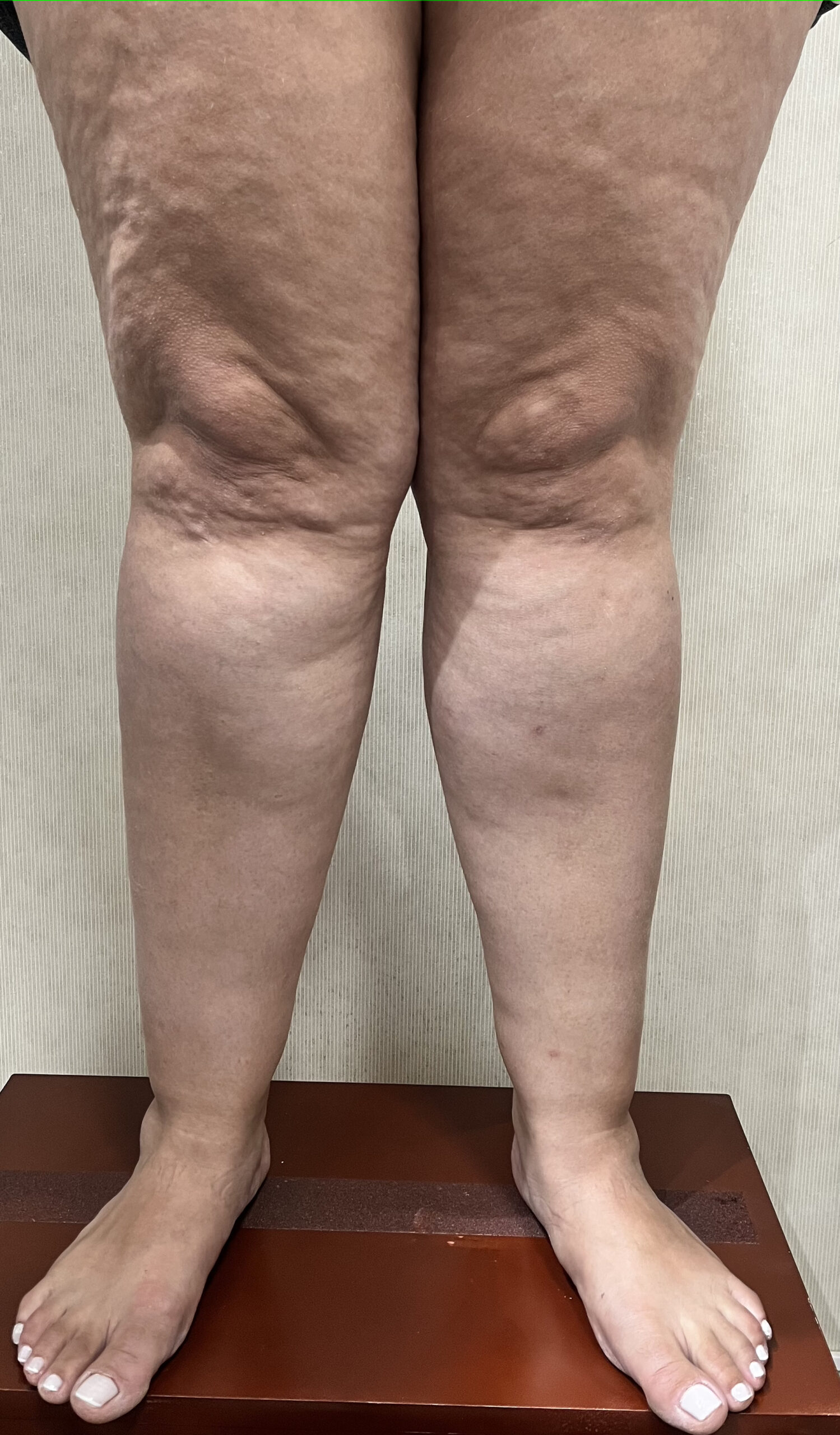 Lipedema: doença que atinge 12,3% das mulheres - Dra Eduarda Costa